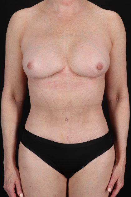 All Me Augmentation Before & After Patient #1910