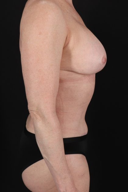 All Me Augmentation Before & After Patient #1910