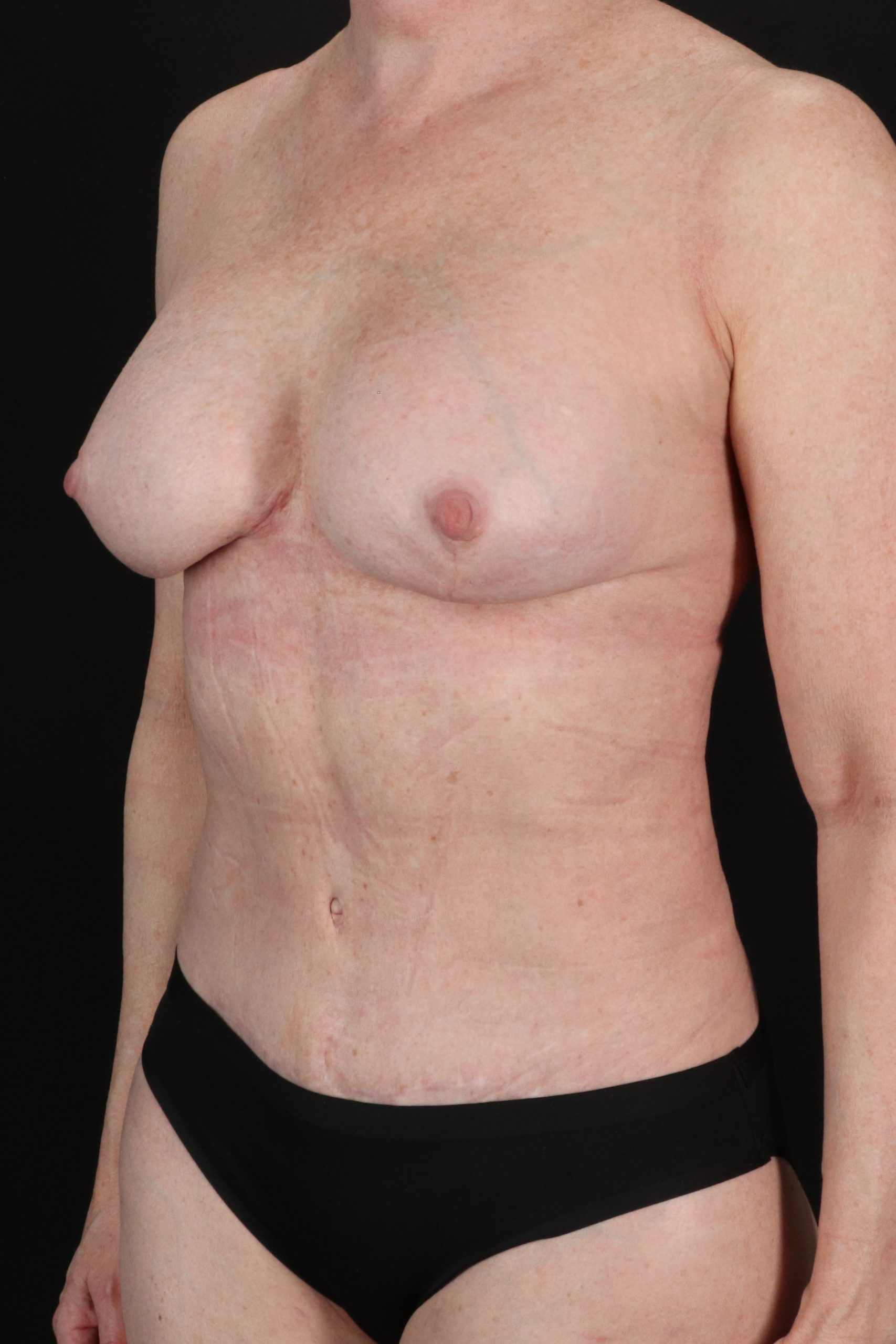 All Me Augmentation Before & After Patient #1910