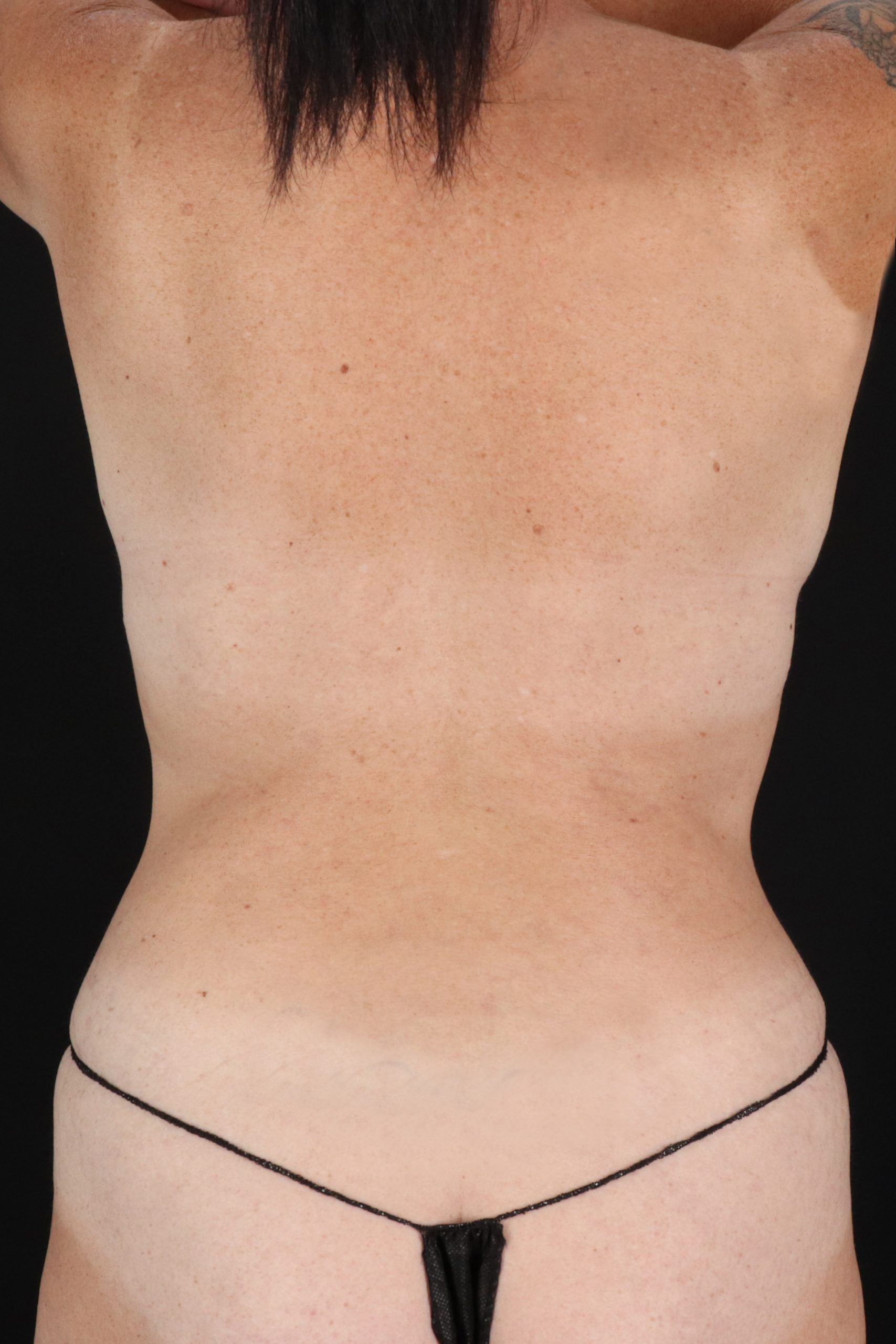 All Me Augmentation Before & After Patient #2105