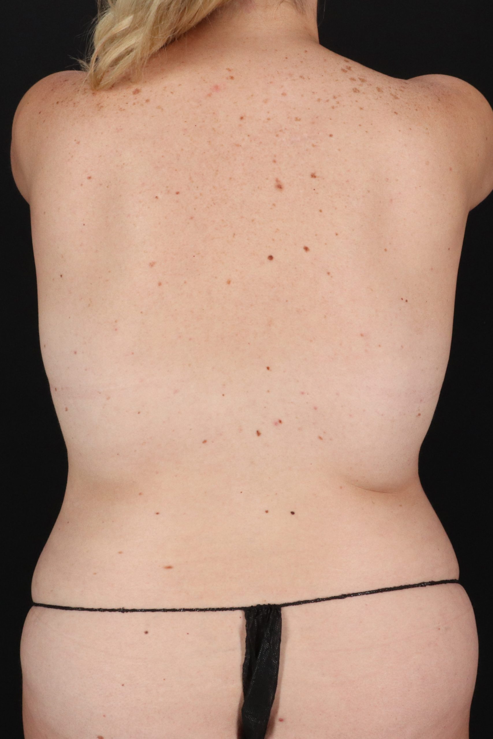 All Me Augmentation Before & After Patient #2106