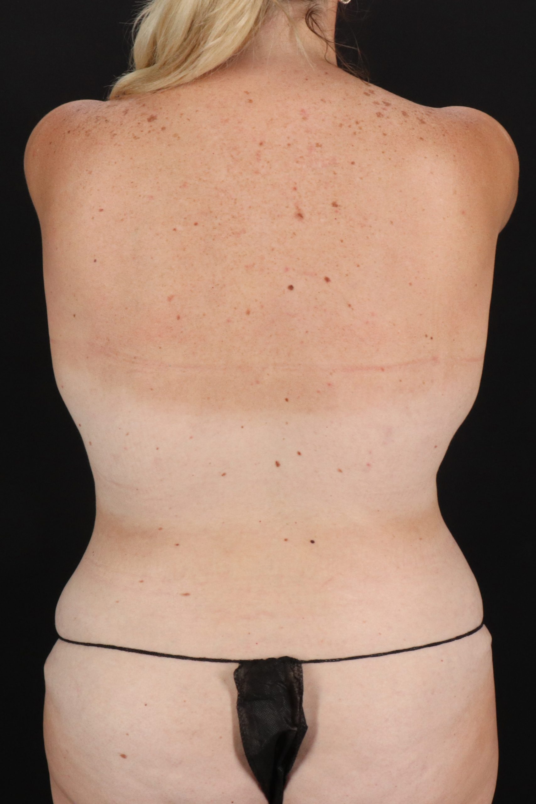 All Me Augmentation Before & After Patient #2106
