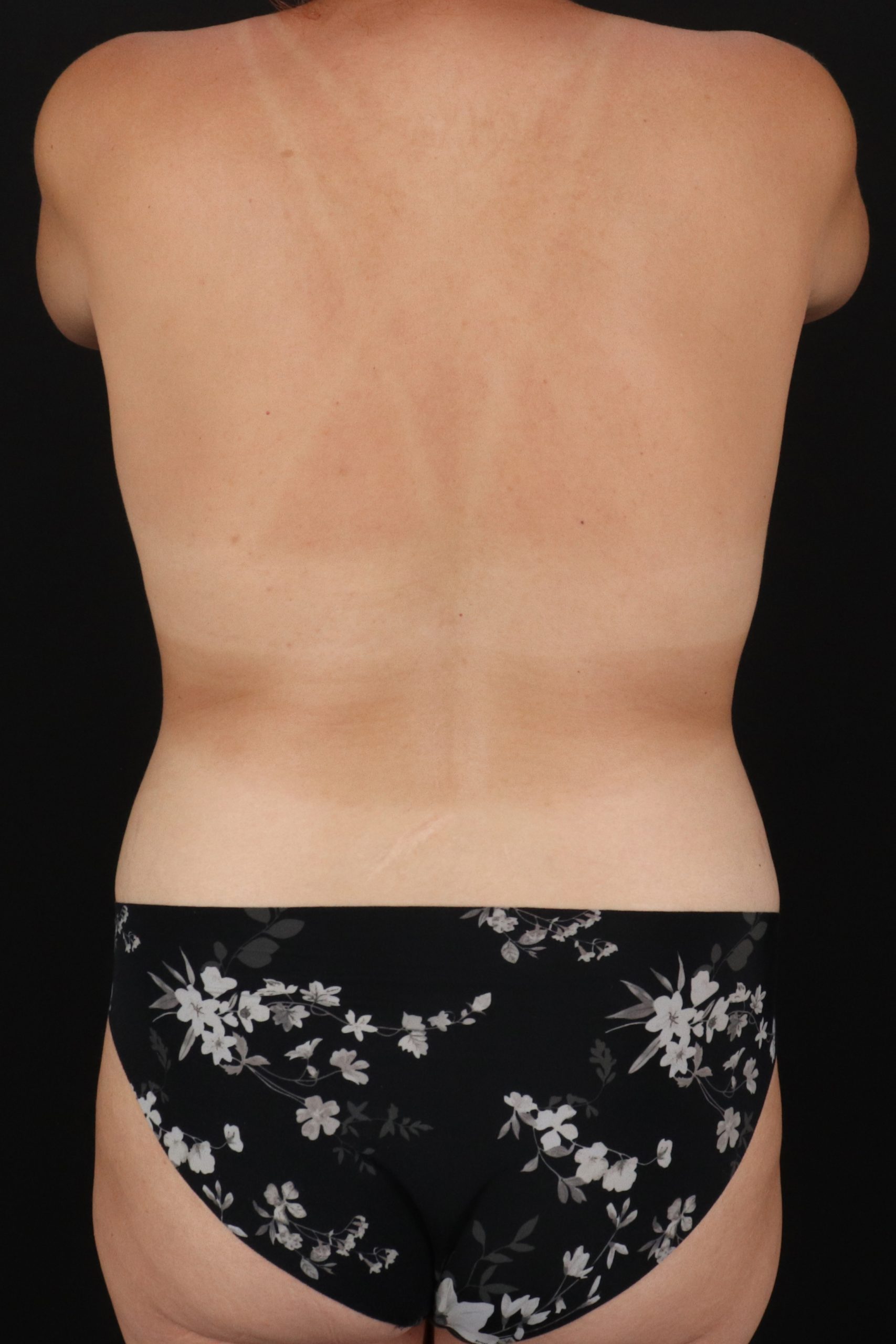 All Me Augmentation Before & After Patient #1895