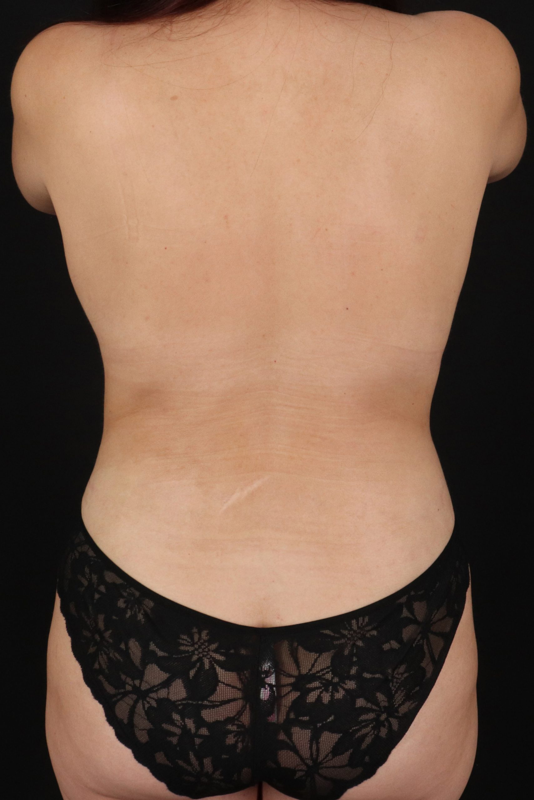 All Me Augmentation Before & After Patient #1895
