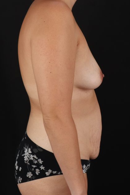 All Me Augmentation Before & After Patient #1895