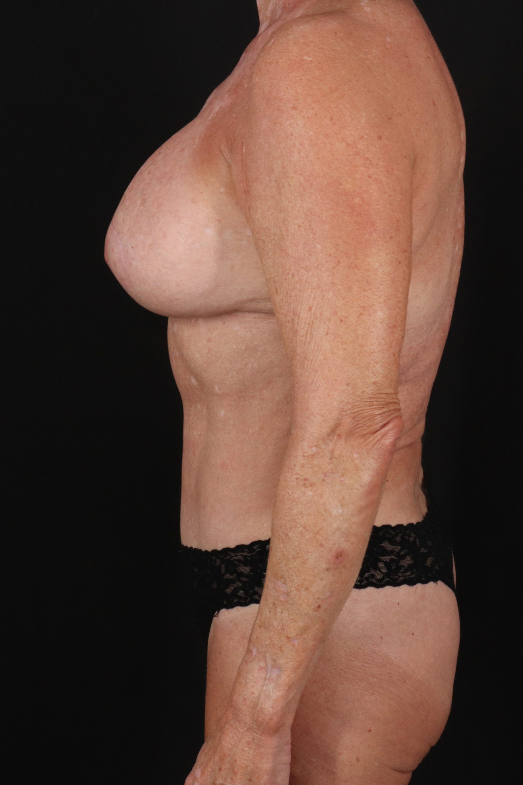 All Me Augmentation Before & After Patient #2107
