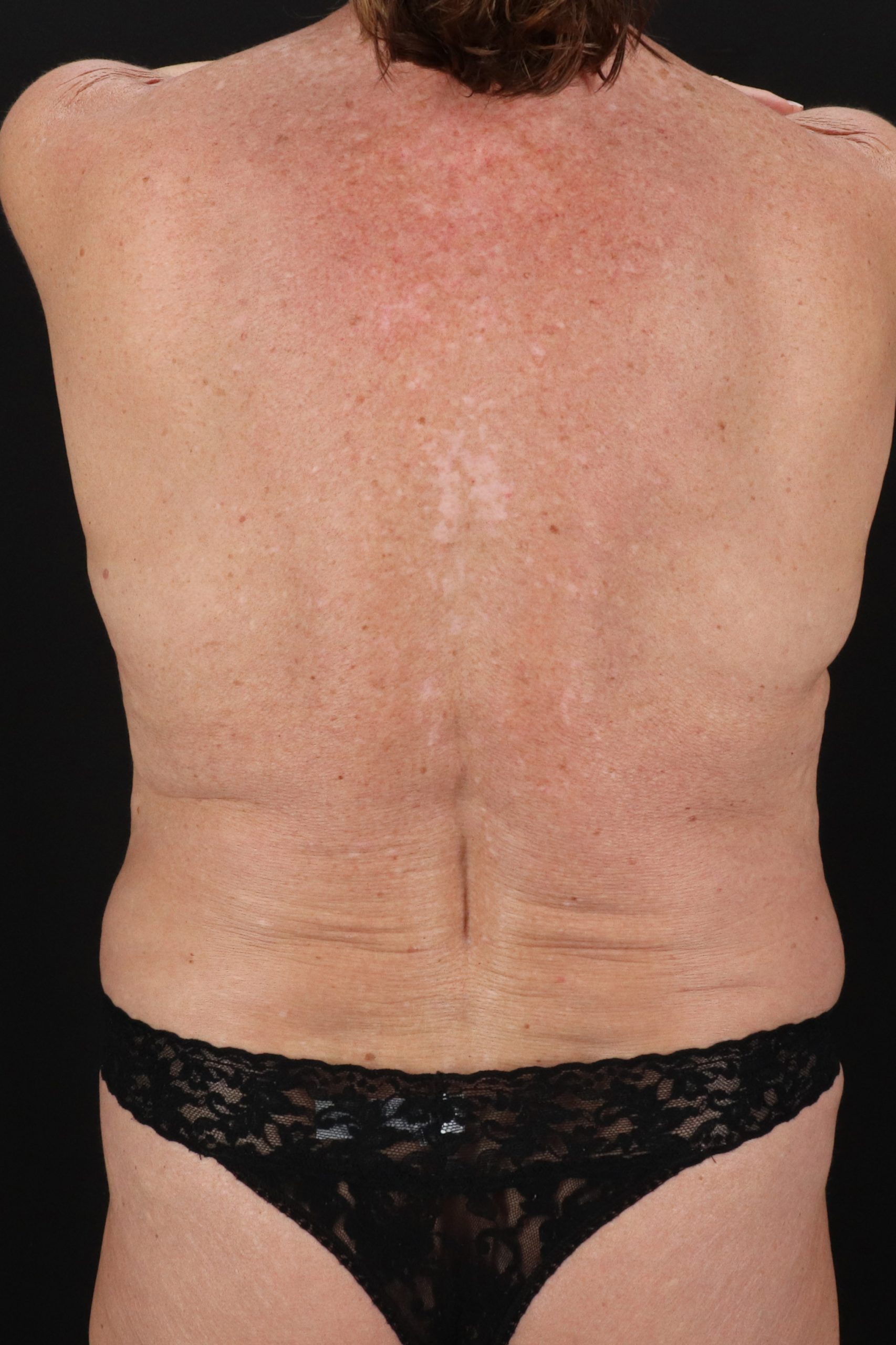All Me Augmentation Before & After Patient #2107