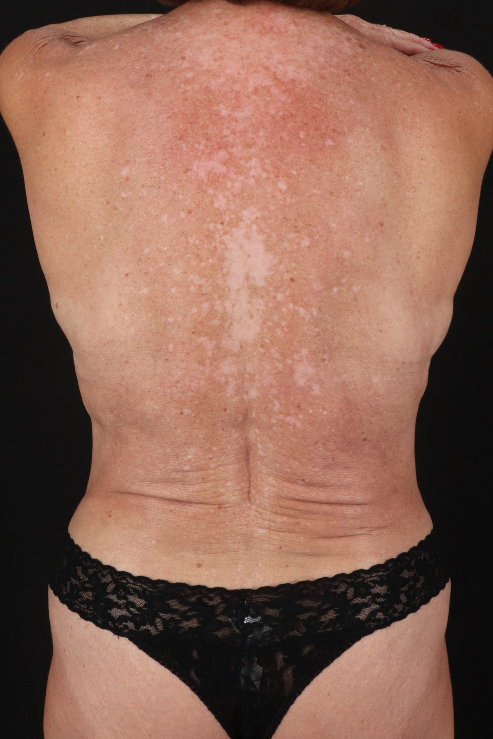 All Me Augmentation Before & After Patient #2107