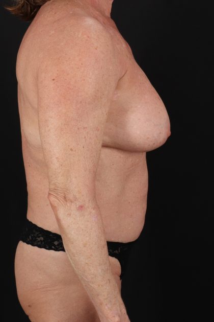 All Me Augmentation Before & After Patient #2107