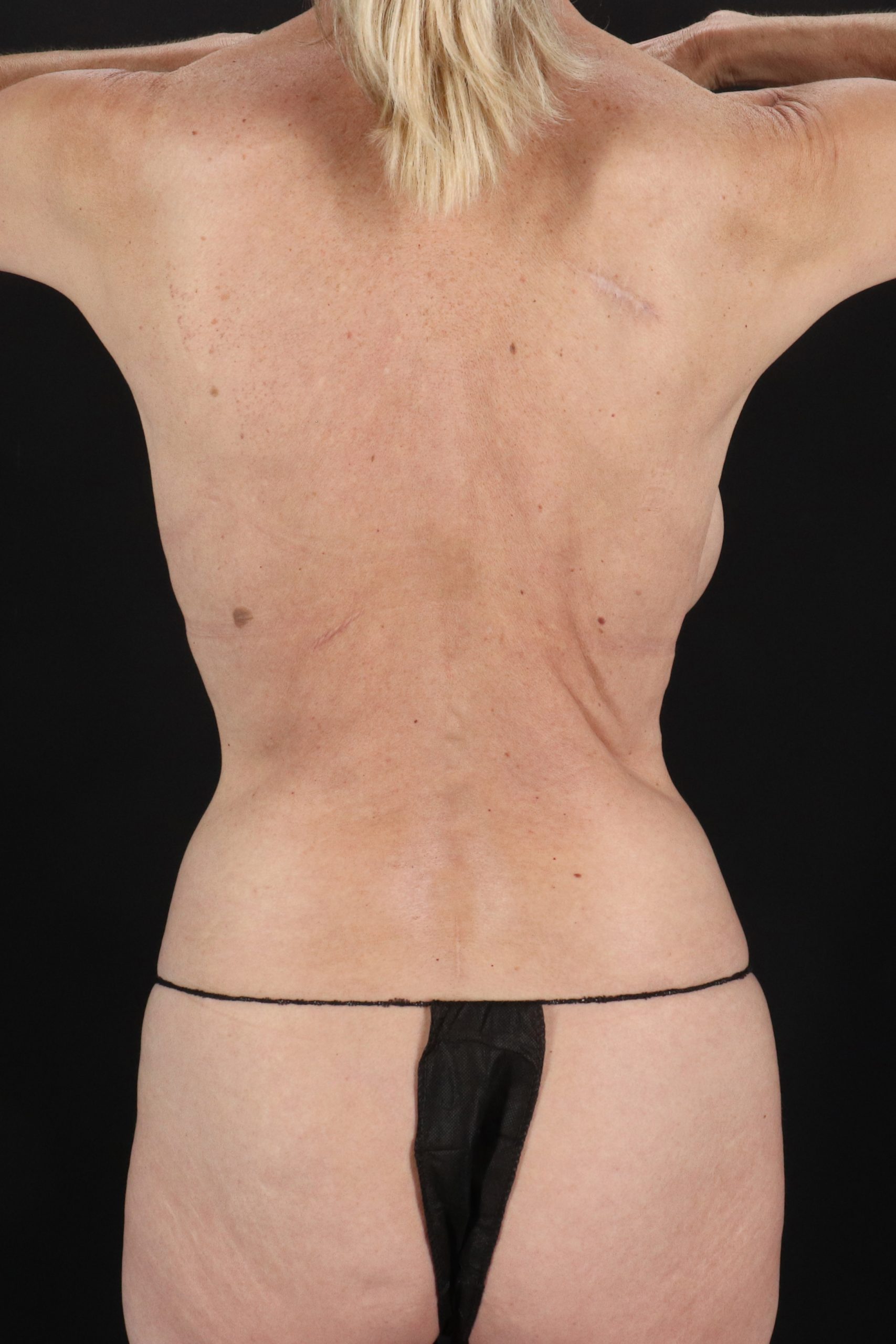All Me Augmentation Before & After Patient #2108