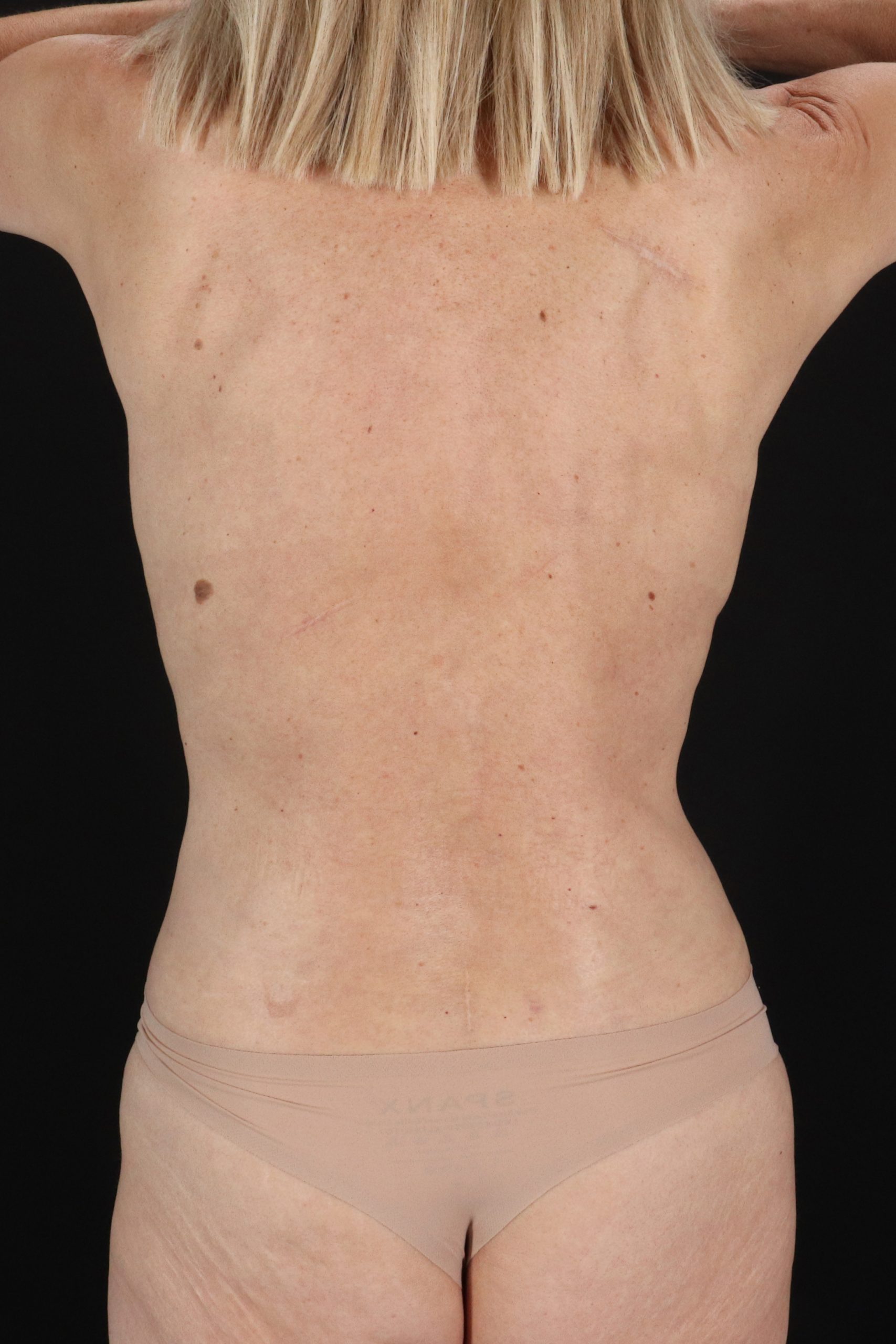 All Me Augmentation Before & After Patient #2108