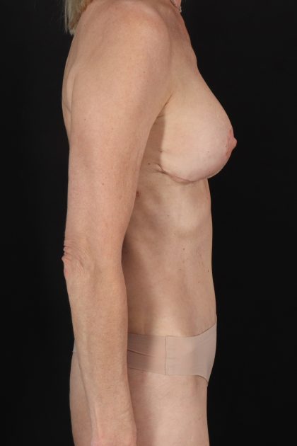 All Me Augmentation Before & After Patient #2108