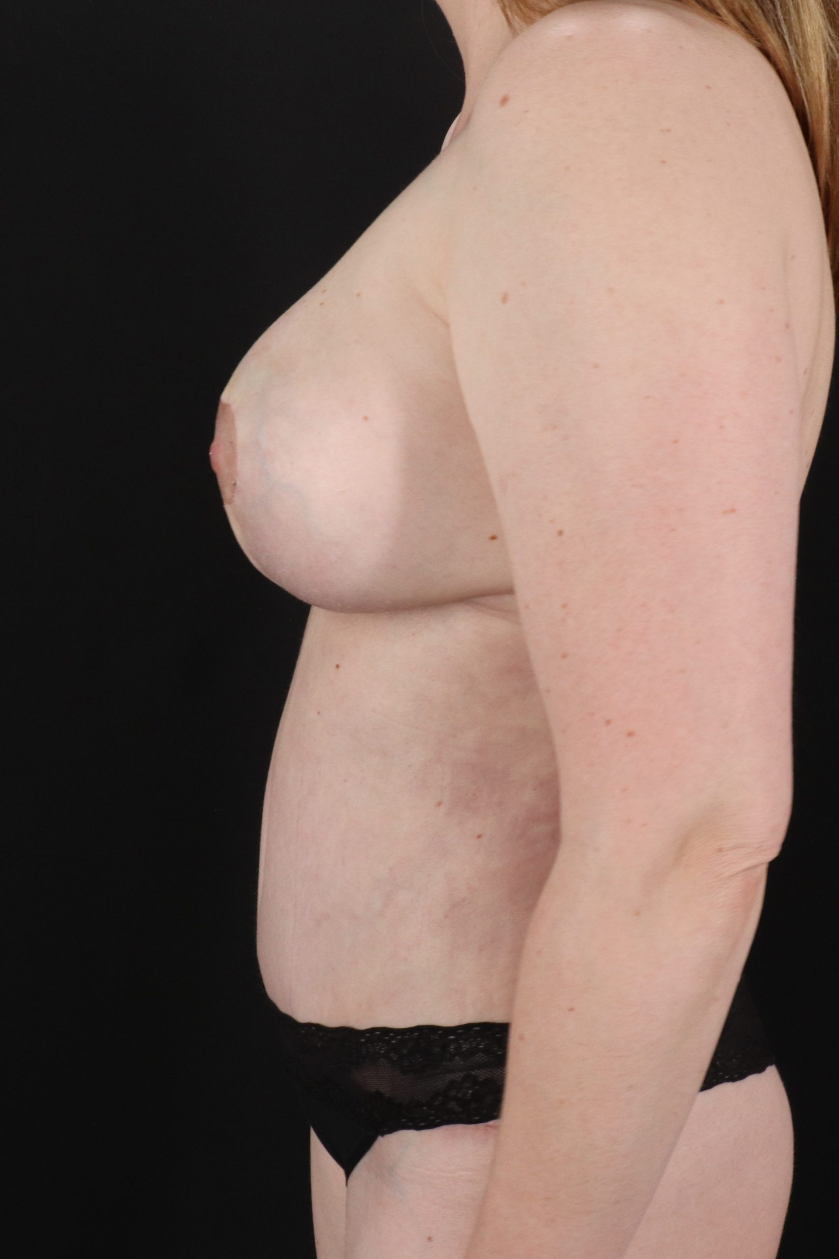 All Me Augmentation Before & After Patient #2109