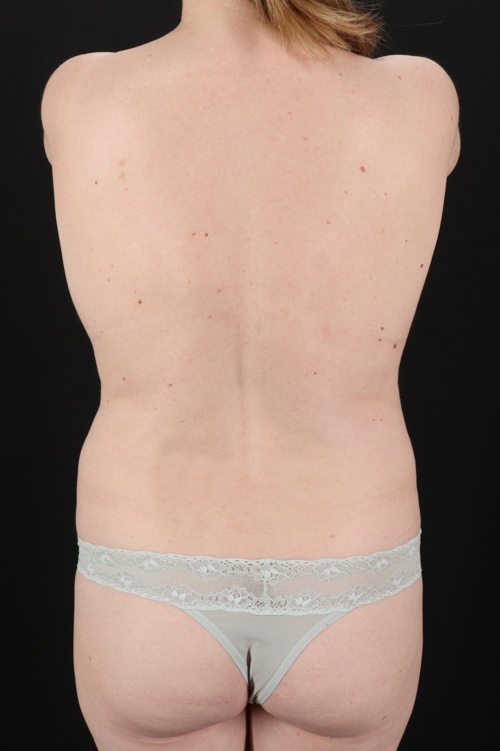 All Me Augmentation Before & After Patient #2109