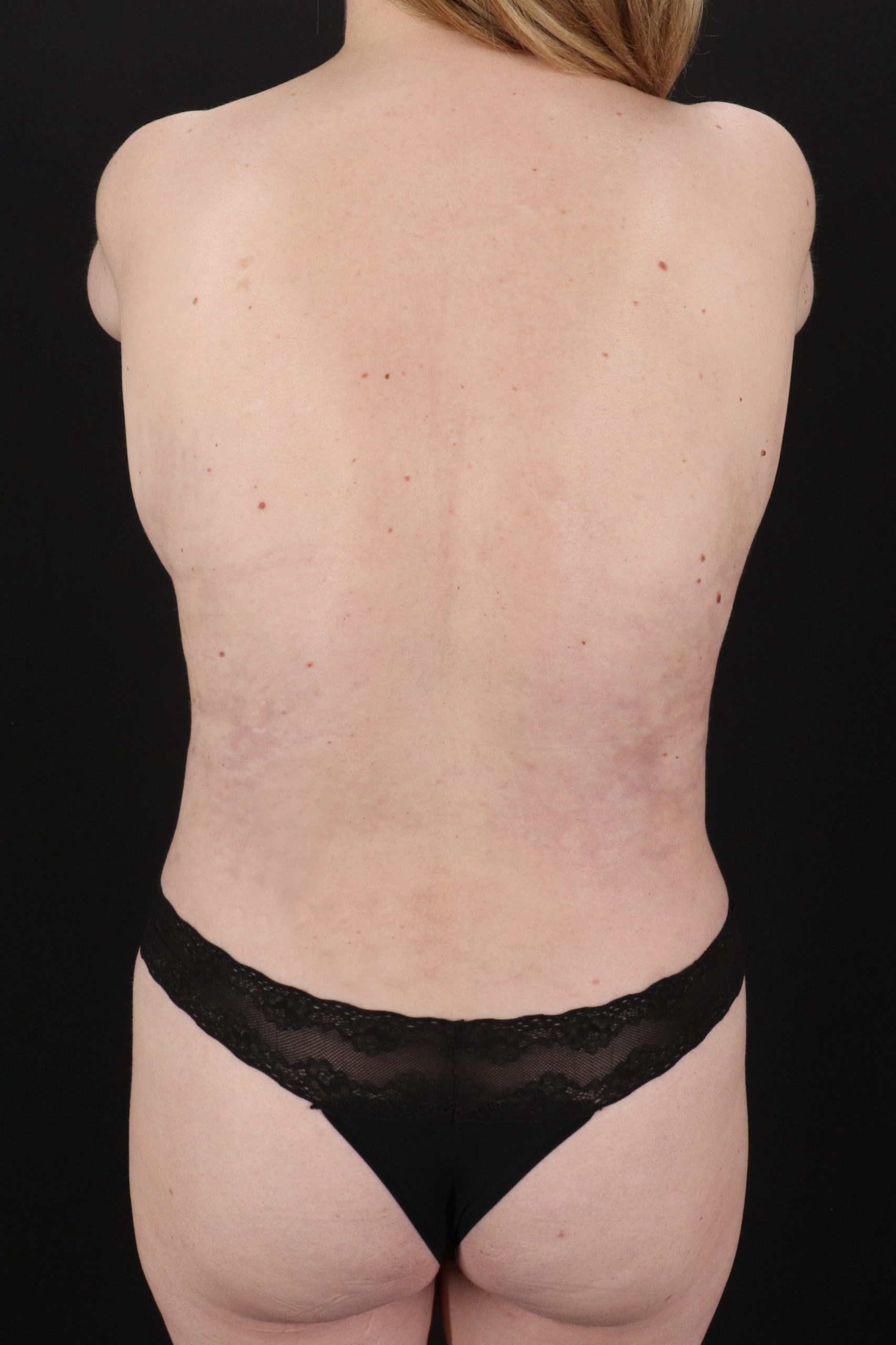 All Me Augmentation Before & After Patient #2109