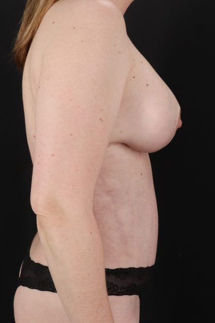 All Me Augmentation Before & After Patient #2109