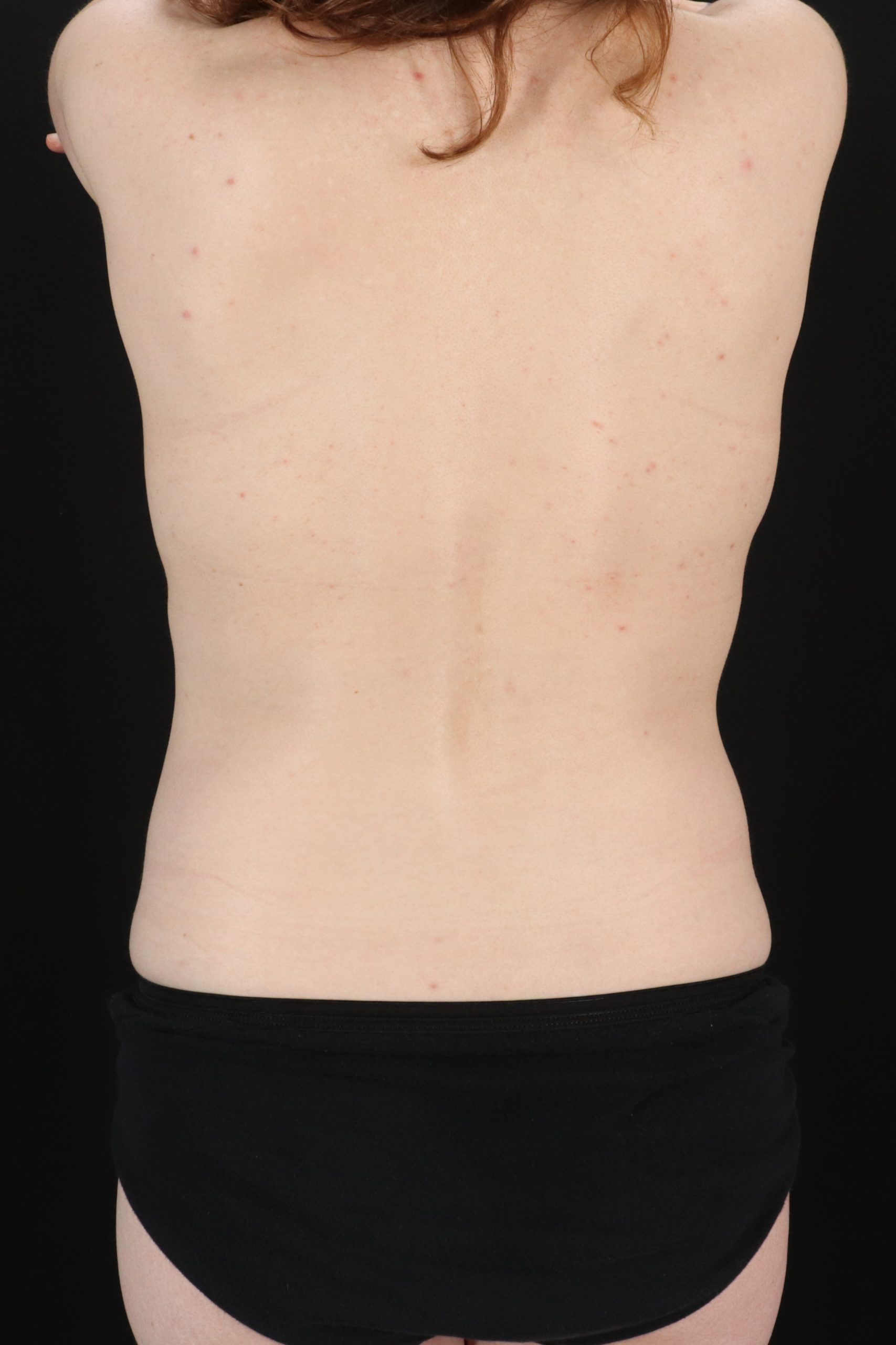 All Me Augmentation Before & After Patient #2110