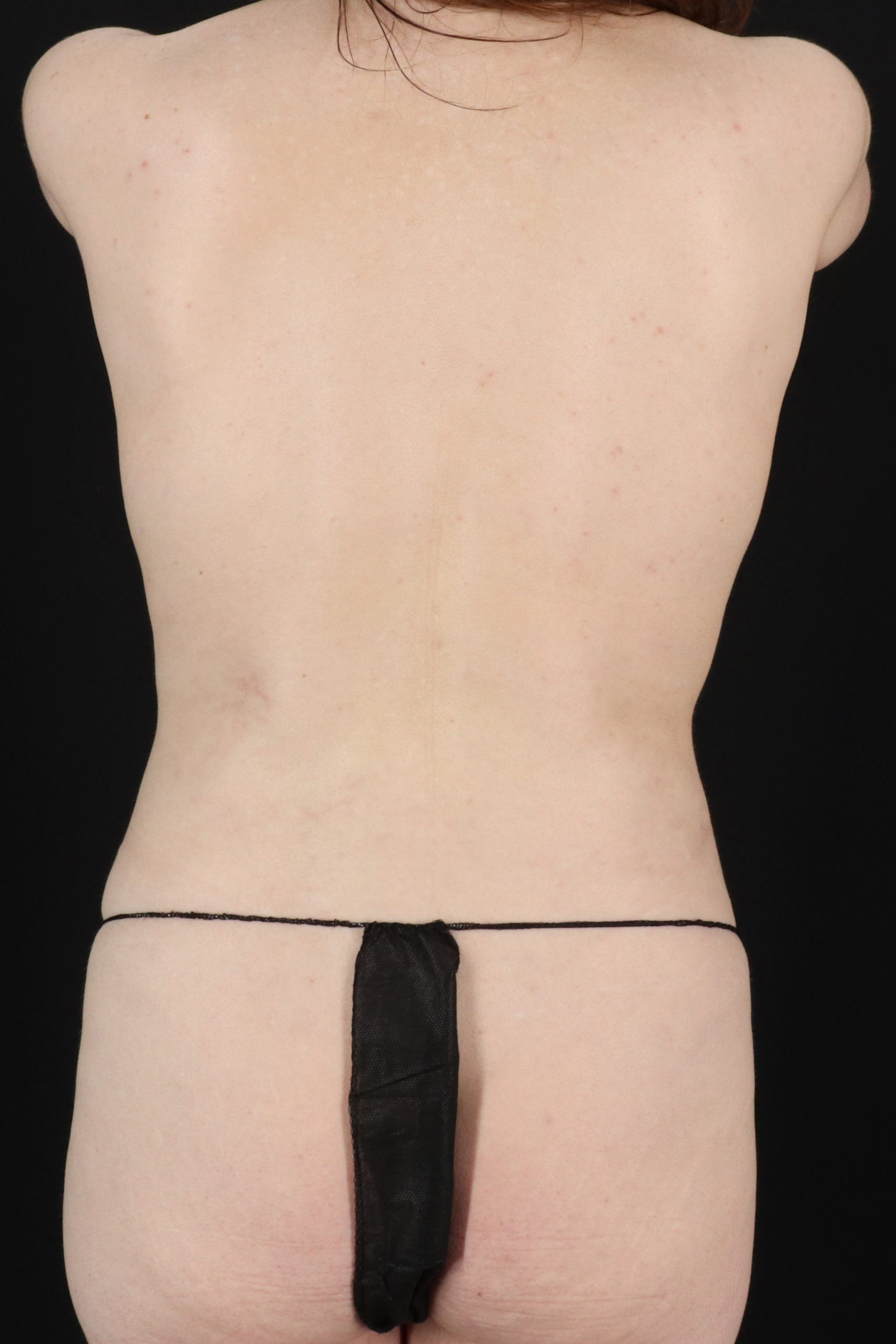 All Me Augmentation Before & After Patient #2110