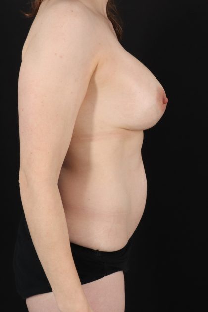 All Me Augmentation Before & After Patient #2110