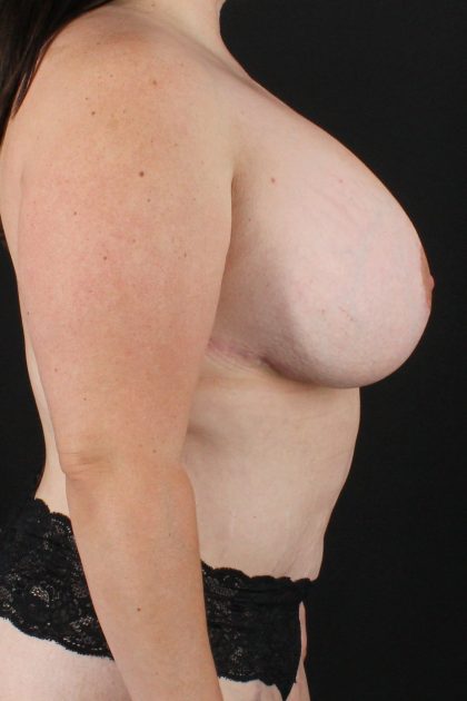 All Me Augmentation Before & After Patient #2112