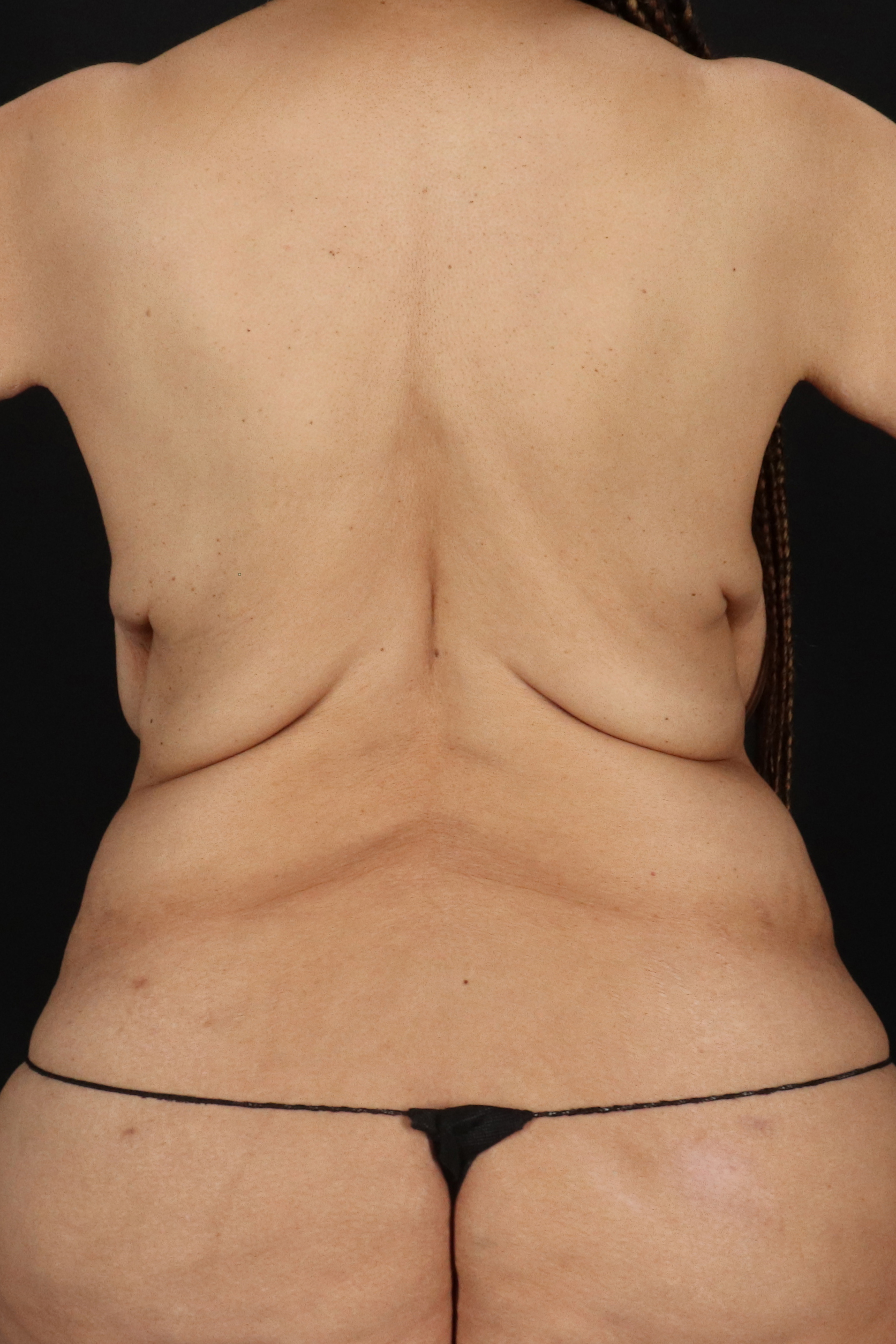 All Me Augmentation Before & After Patient #2113