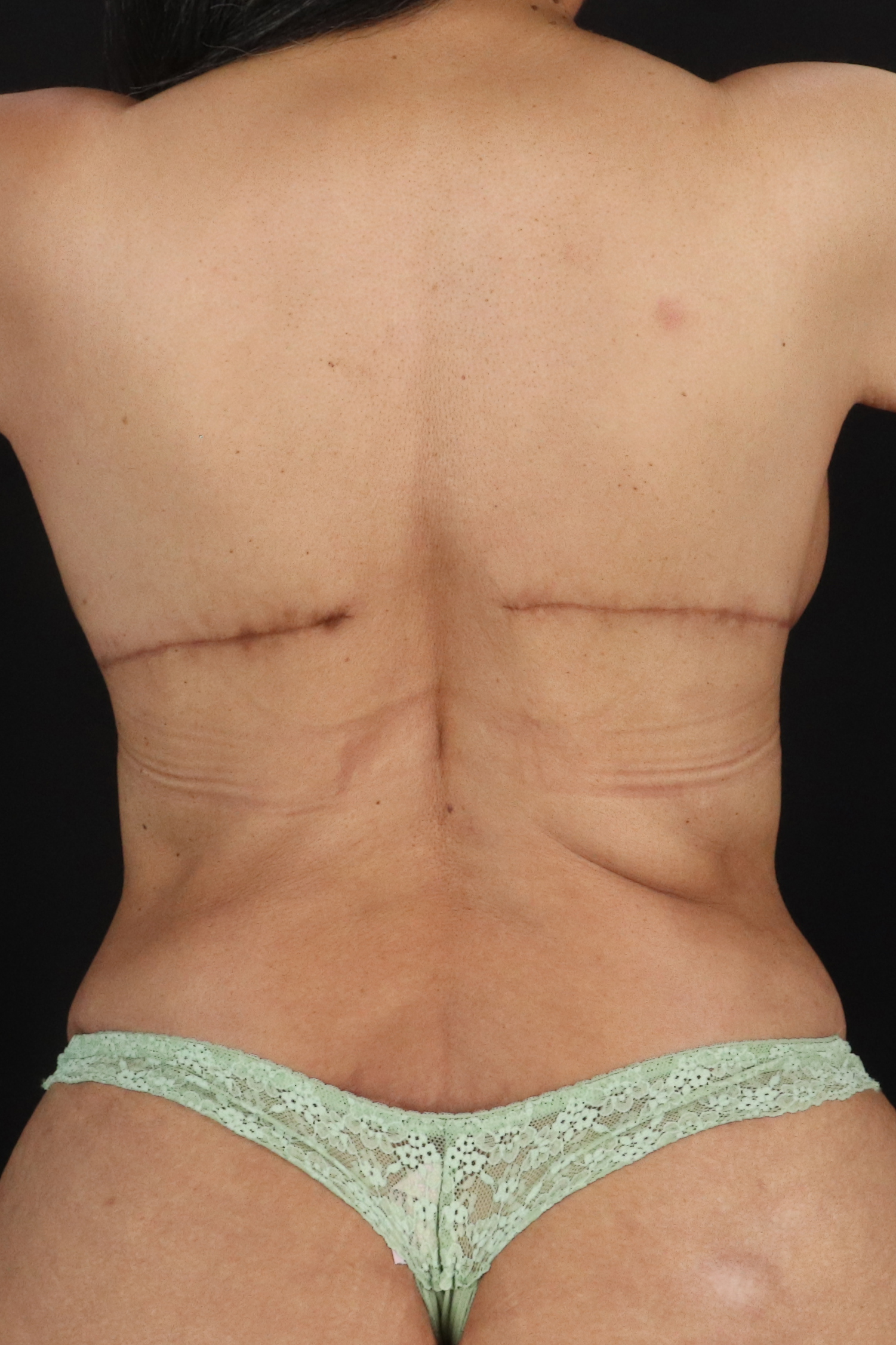 All Me Augmentation Before & After Patient #2113