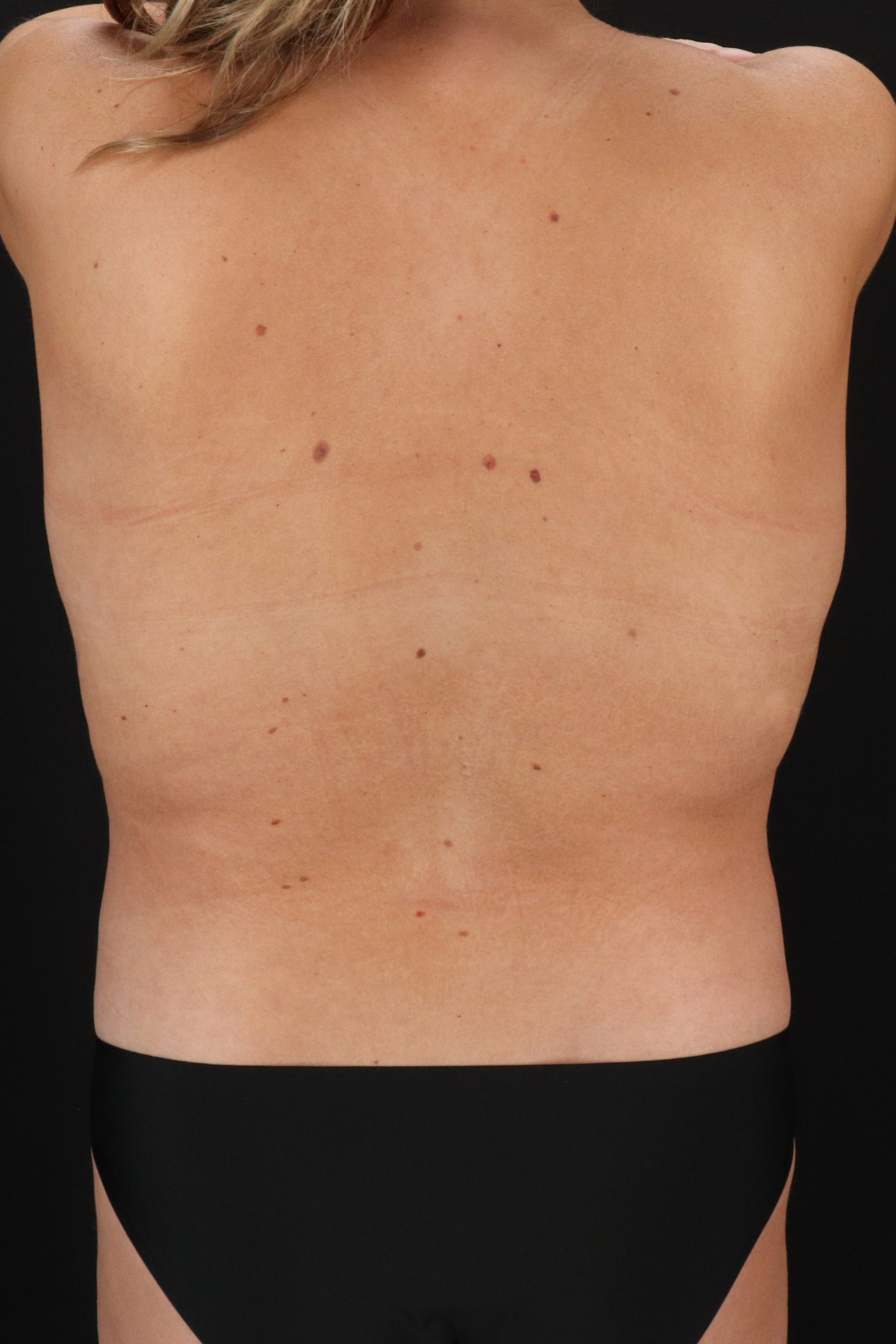 All Me Augmentation Before & After Patient #2114