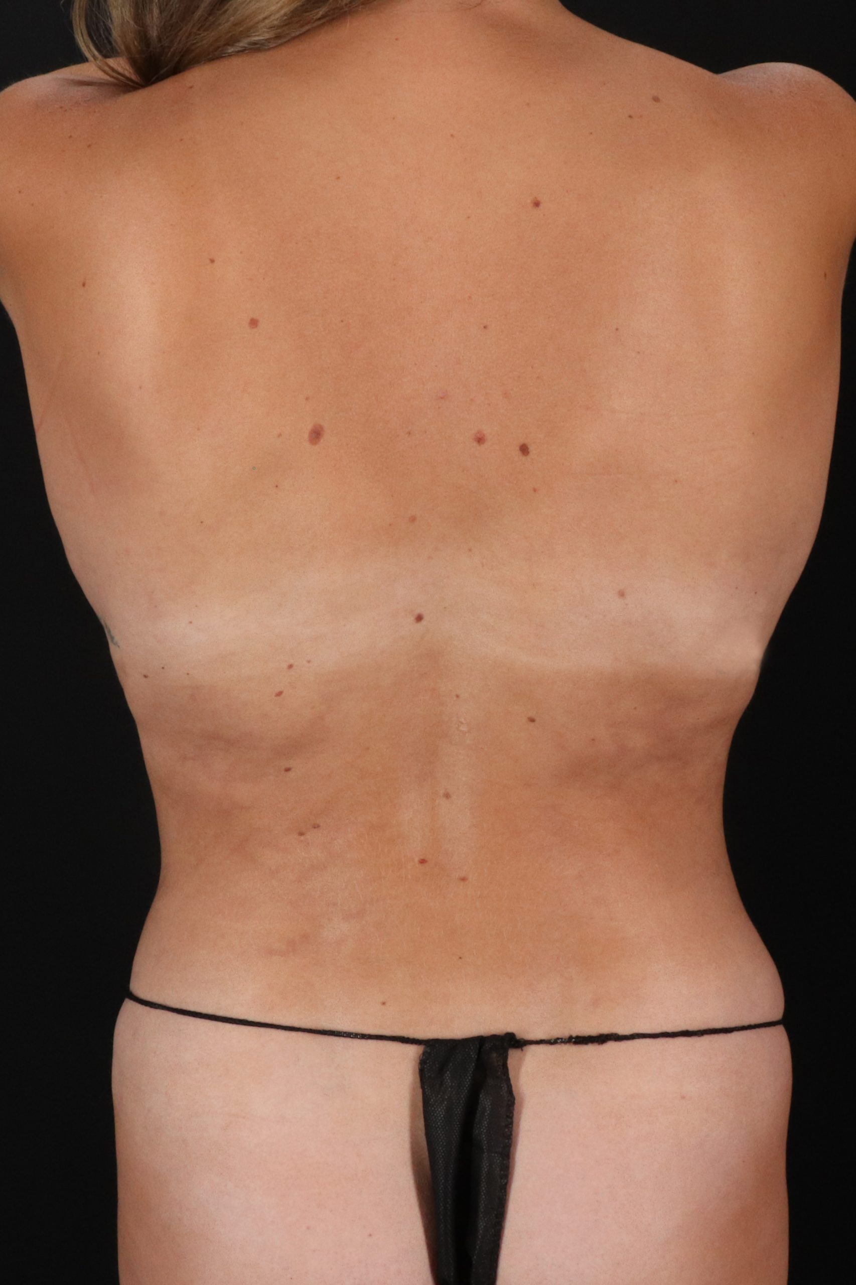All Me Augmentation Before & After Patient #2114