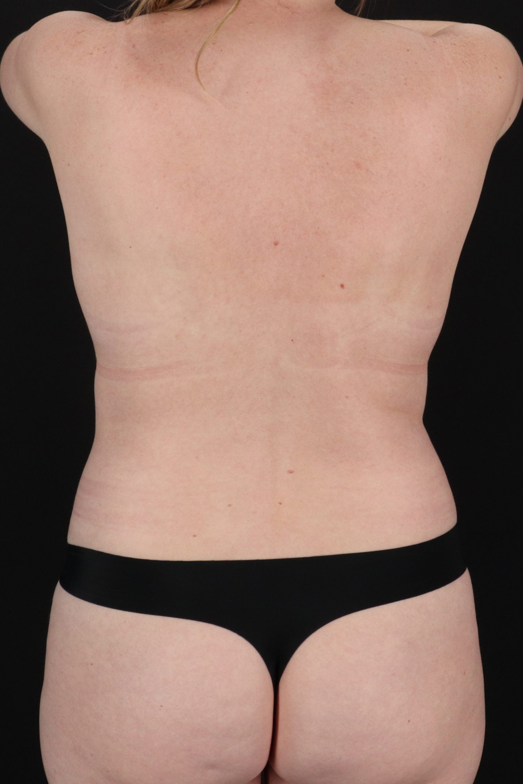 All Me Augmentation Before & After Patient #2115