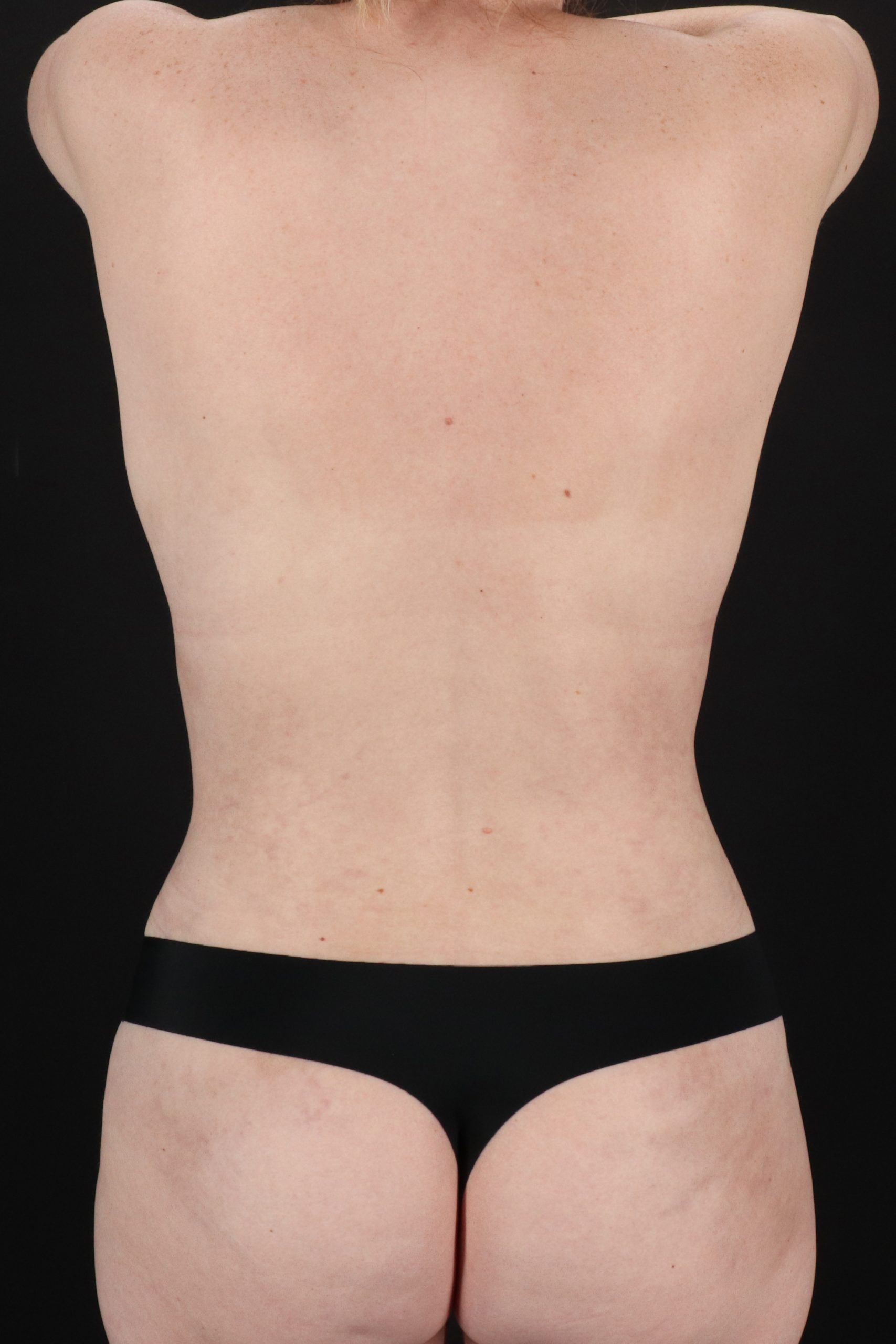 All Me Augmentation Before & After Patient #2115