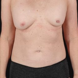 All Me Augmentation Before & After Patient #2116