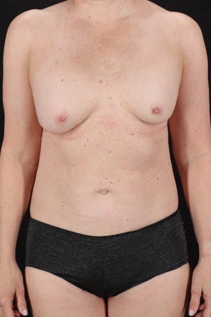 All Me Augmentation Before & After Patient #2116