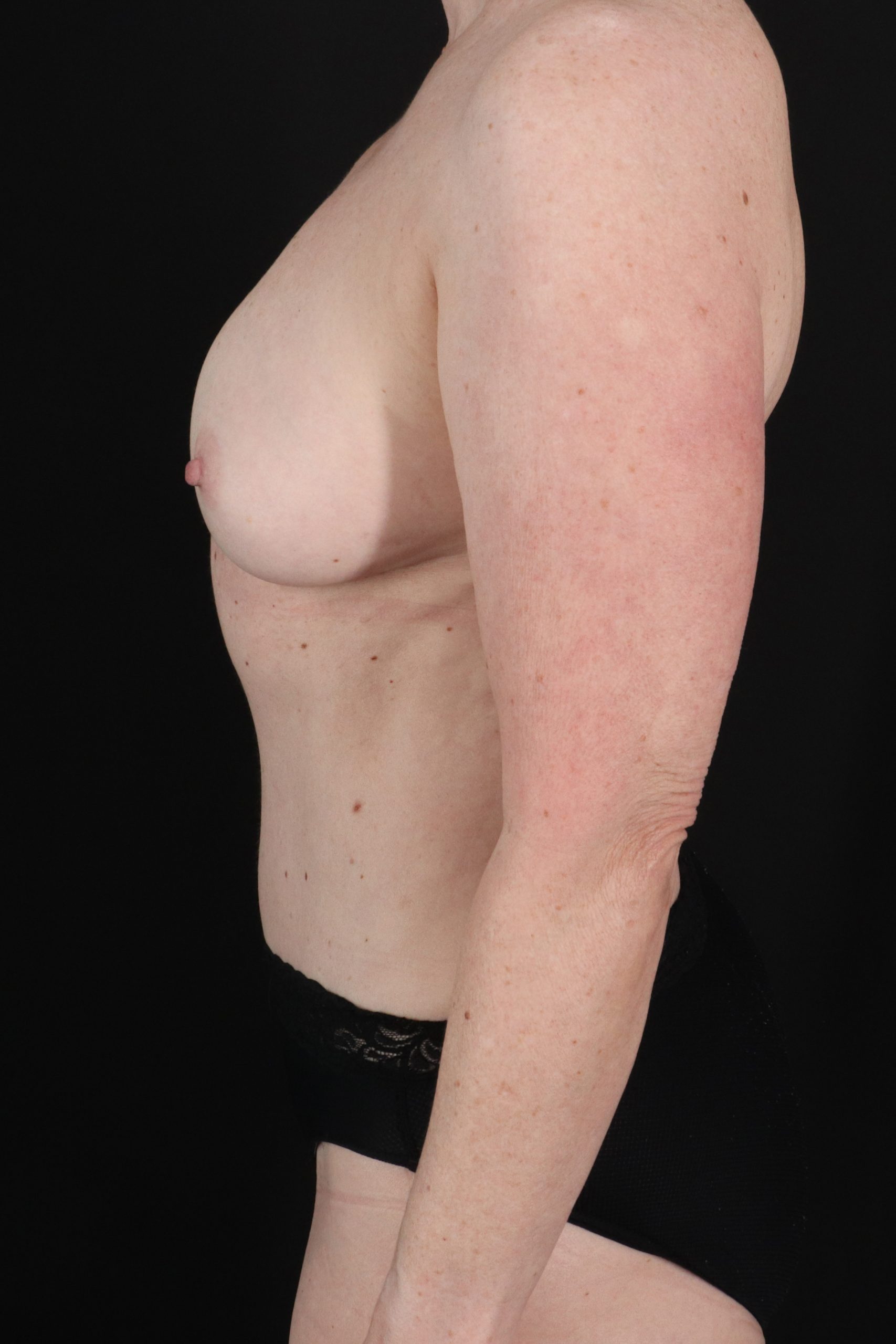 All Me Augmentation Before & After Patient #2116