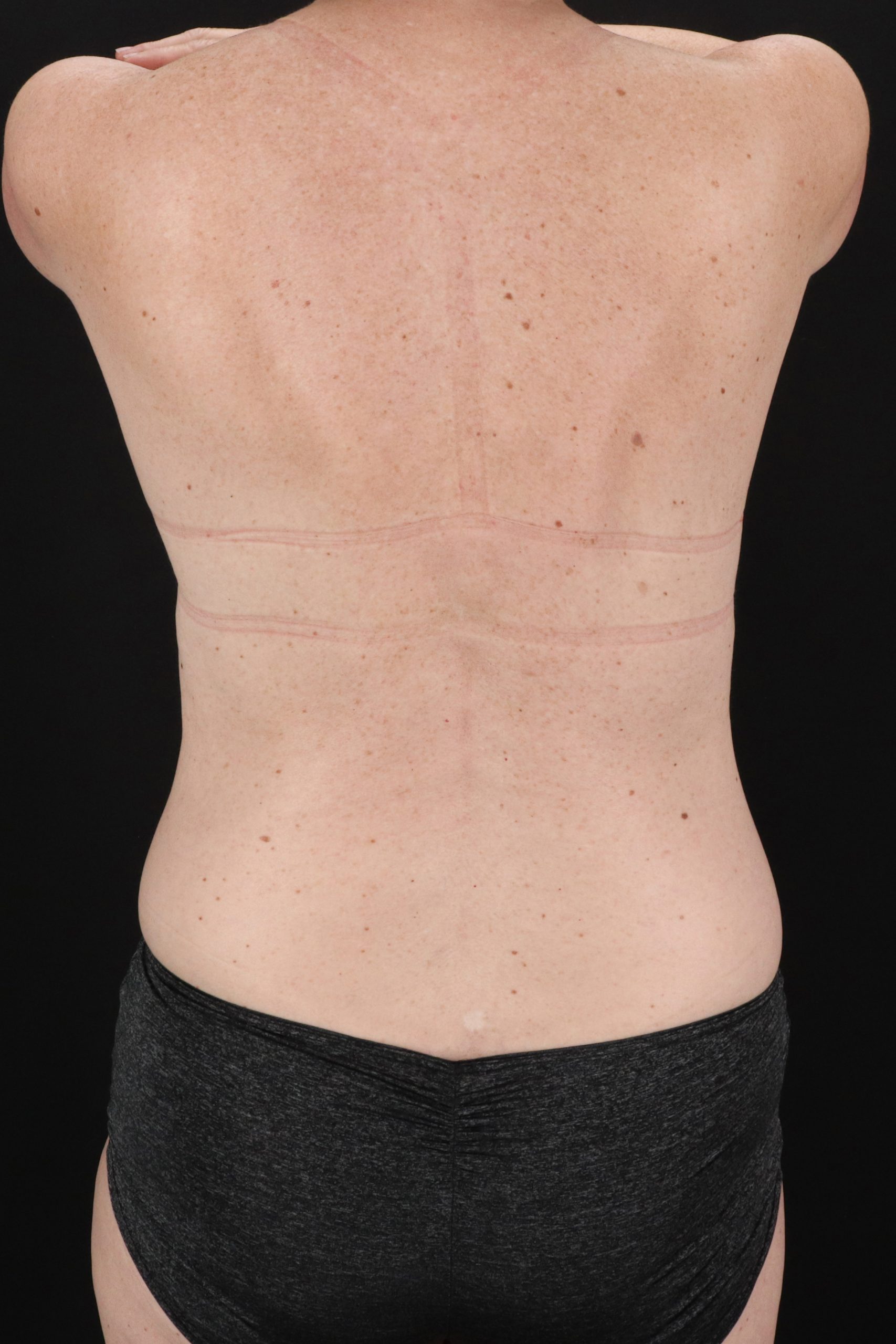 All Me Augmentation Before & After Patient #2116
