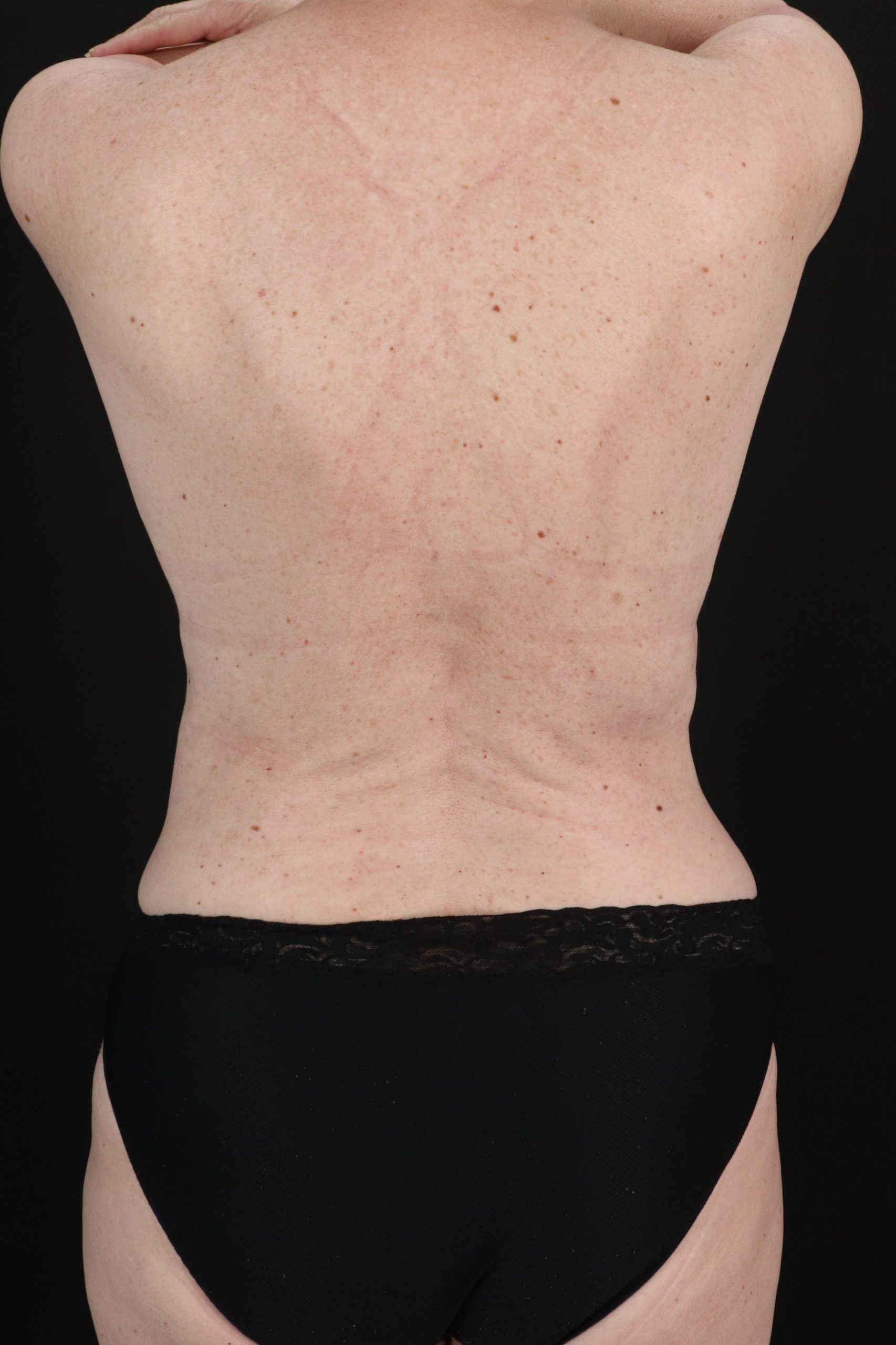 All Me Augmentation Before & After Patient #2116