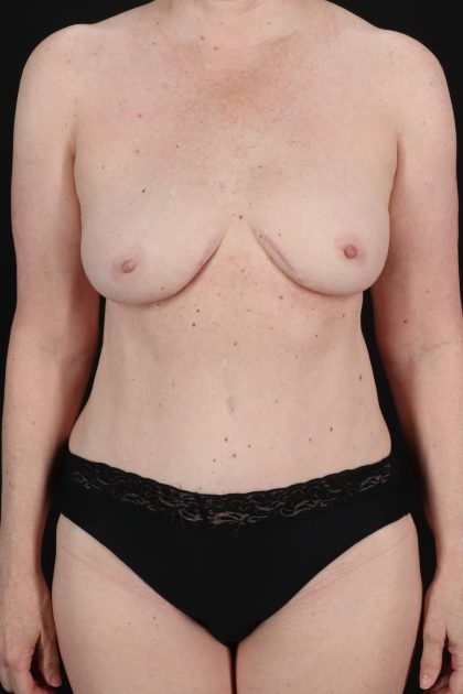 All Me Augmentation Before & After Patient #2116
