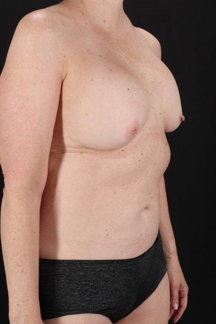 All Me Augmentation Before & After Patient #2116