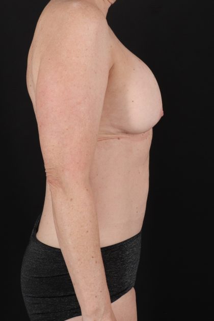 All Me Augmentation Before & After Patient #2116