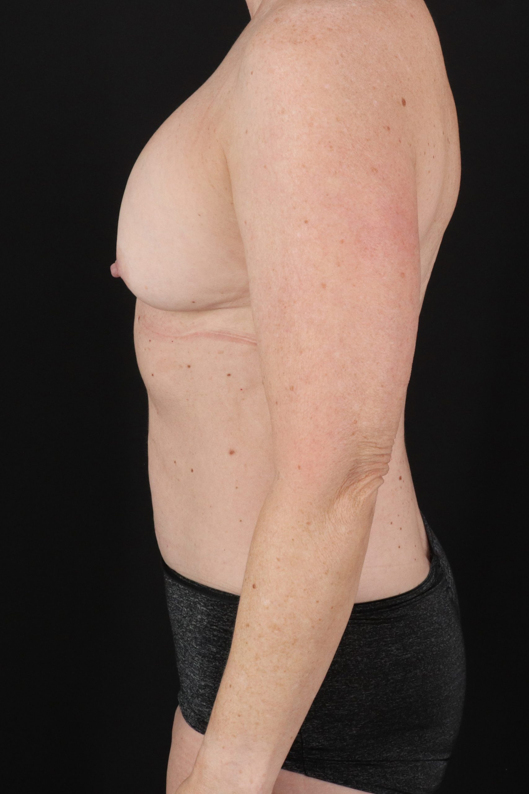 All Me Augmentation Before & After Patient #2116