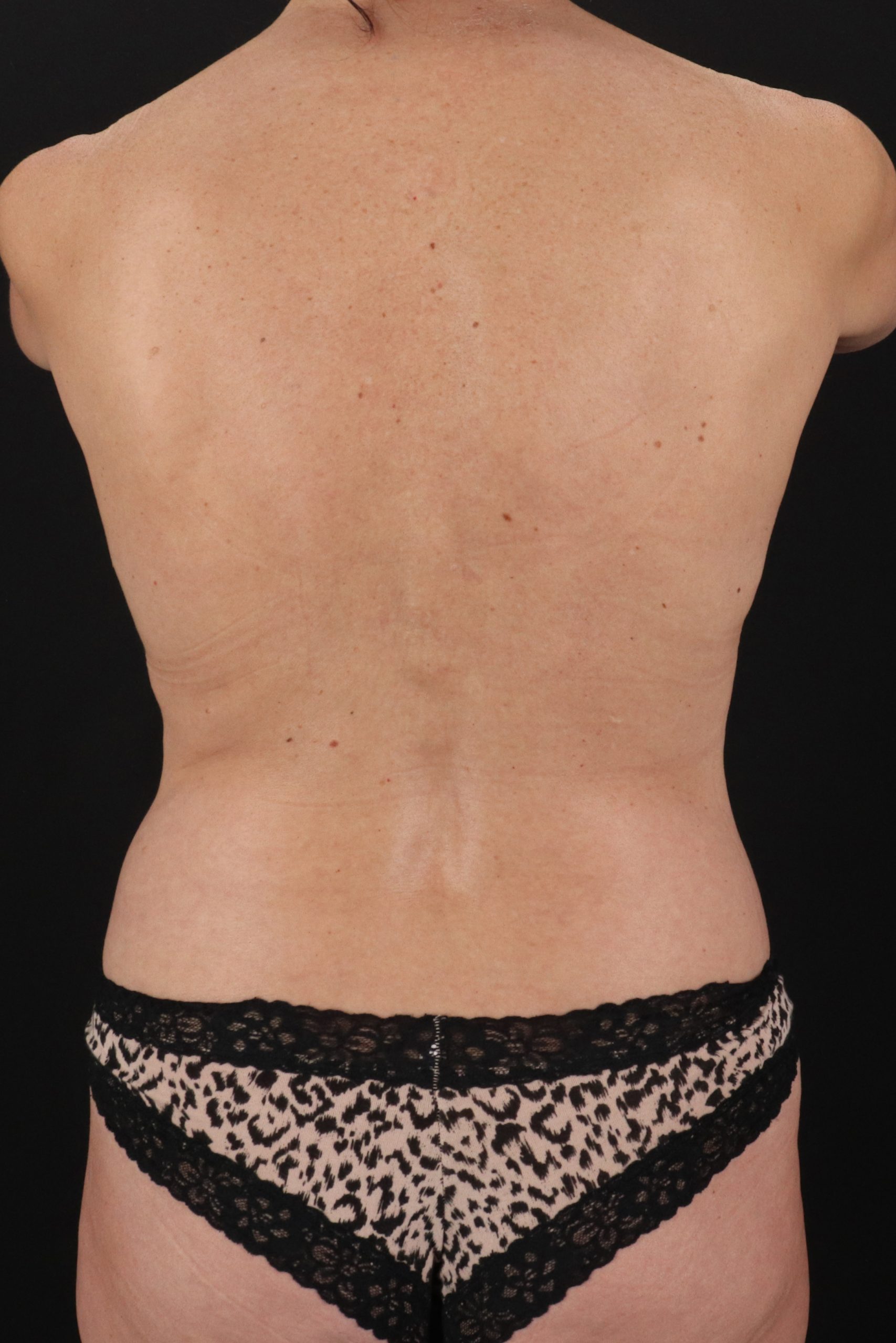 All Me Augmentation Before & After Patient #1896