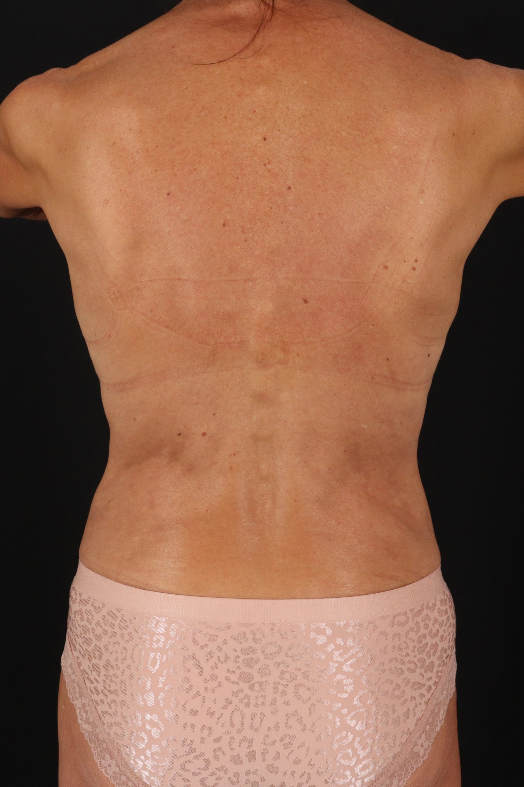 All Me Augmentation Before & After Patient #1896