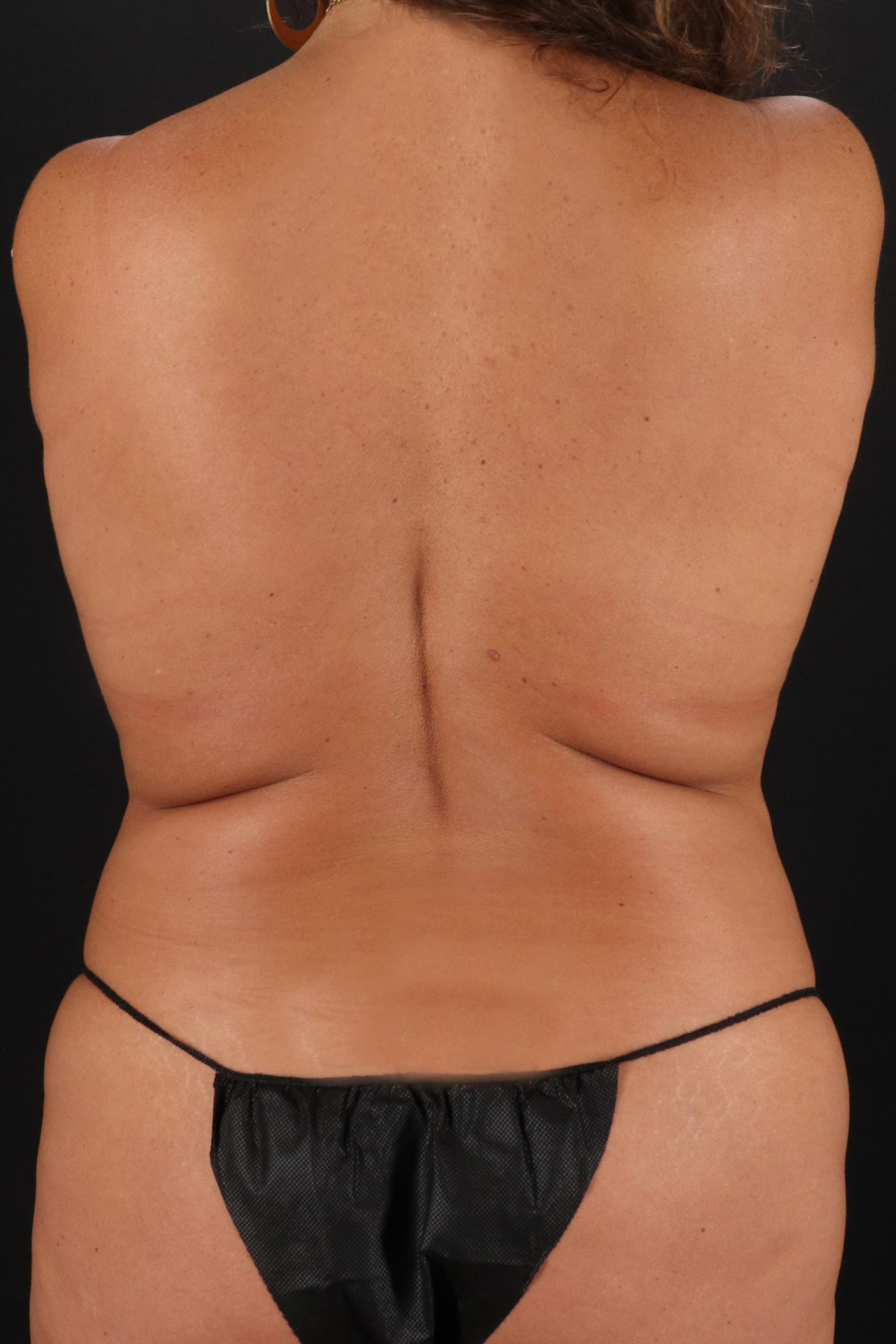 All Me Augmentation Before & After Patient #2117
