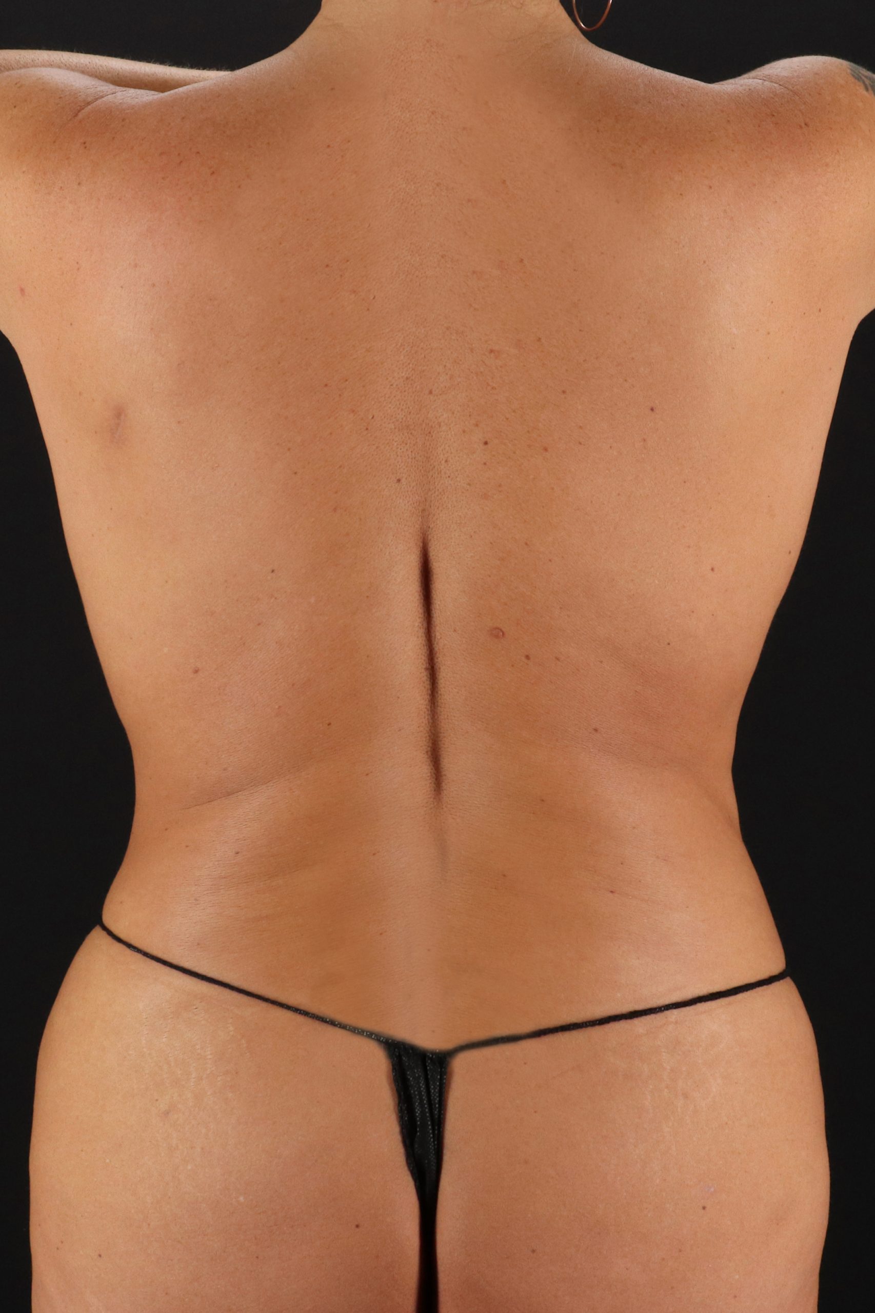 All Me Augmentation Before & After Patient #2117