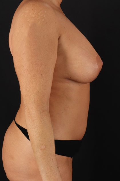 All Me Augmentation Before & After Patient #2117