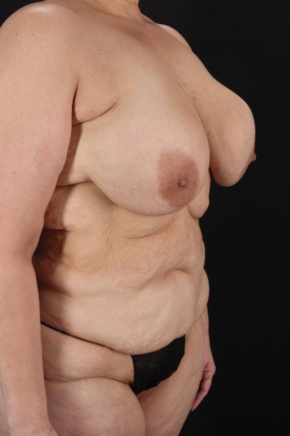 All Me Augmentation Before & After Patient #2118
