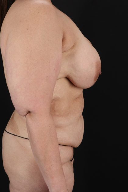 All Me Augmentation Before & After Patient #2118