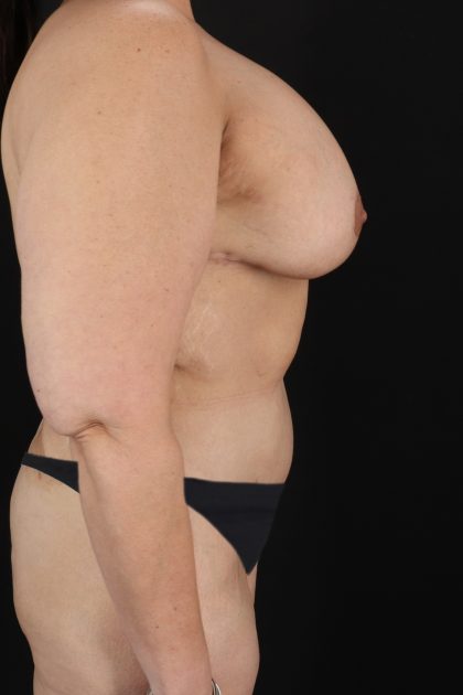 All Me Augmentation Before & After Patient #2118