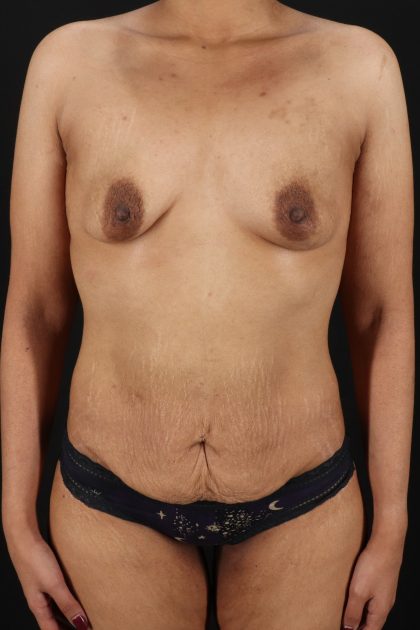 All Me Augmentation Before & After Patient #2119