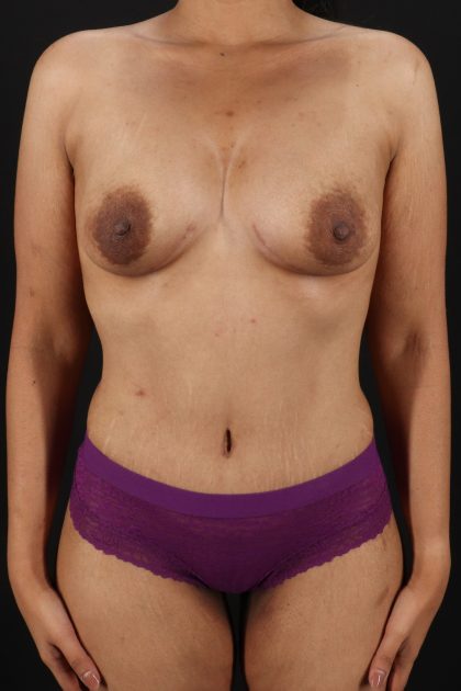 All Me Augmentation Before & After Patient #2119