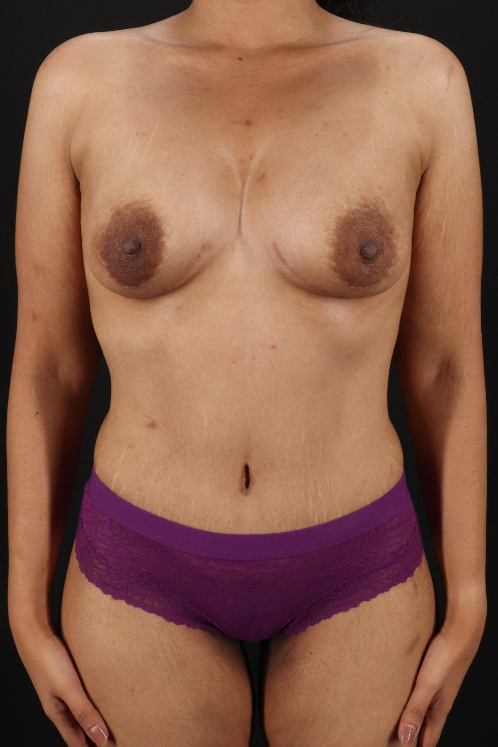 All Me Augmentation Before & After Patient #2119
